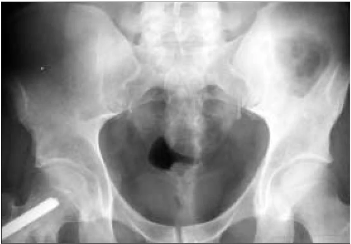 RTG pánve: osteolytické ložisko lopaty kosti kyčelní vlevo.