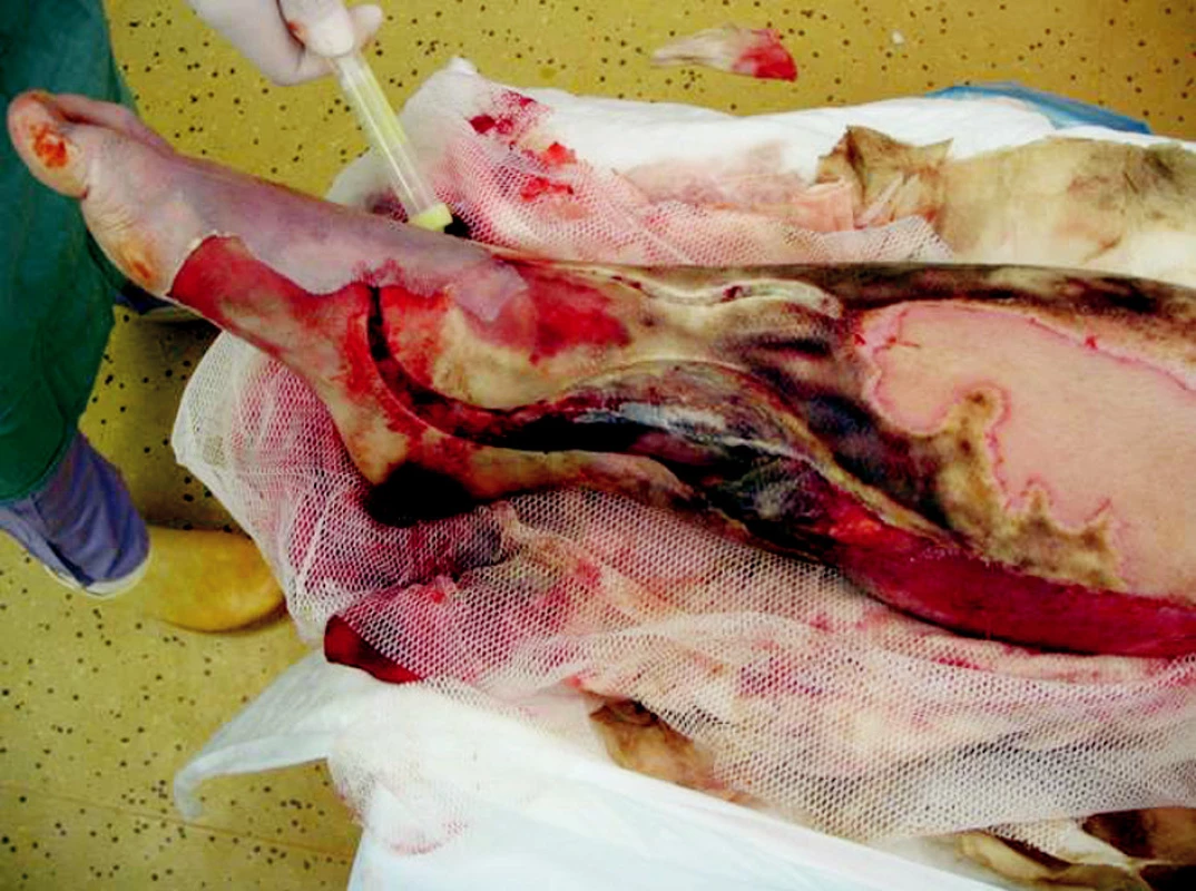 Right shank sixth day after the injury