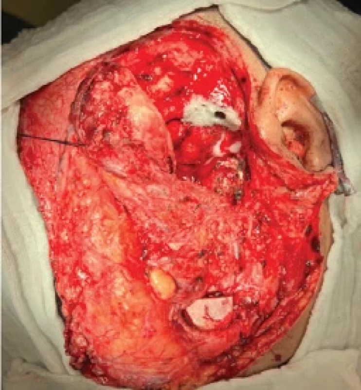 Infratemporal fossa after extirpation of the tumor and condyle resection – fi rst case.