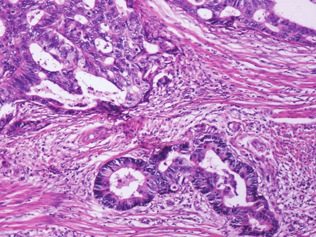 Kazuistika 1 – adenokarcinom tlustého střeva s tubulárním uspořádáním (HE, 40x)
Fig. 1: Case 1 – colonic adenocarcinoma with tubular arrangement (HE, 40x)