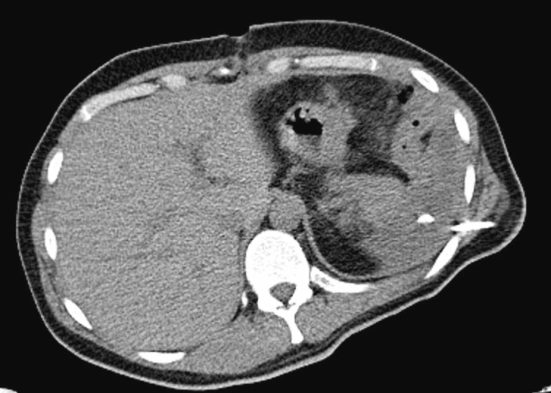 CT vyšetření – stav po splenektomii, drenáž subfrenického abscesu. Pankreatický vývod nepoškozen
Fig. 3. CT examination – Post-splenectomy condition, drainage of the subphrenic absces. The pancreatic duct is intact