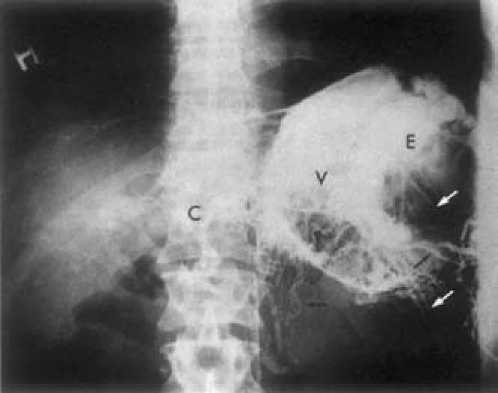 Splenoportografia. Šípky – kolaterály cez interkostálne vény. V – gastrické varixy, C – koronárna véna [11].
Fig. 1. Splenoportography. Arrows – collaterals through intercostal veins. V – gastric varices, C – coronary vein [11].