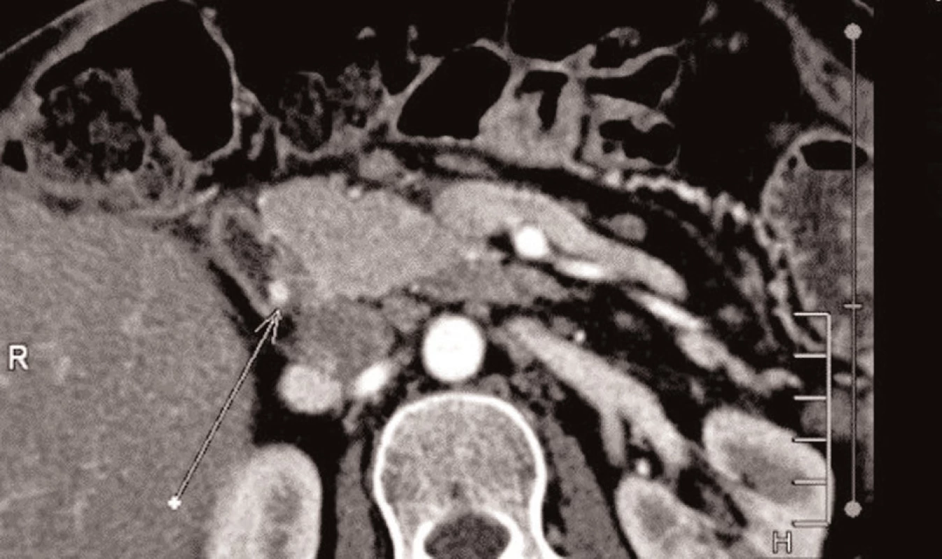 Pooperační CT s reziduální lézí v duodenu
Fig. 4: Postoperative CT scan with a residual duodenal lesion