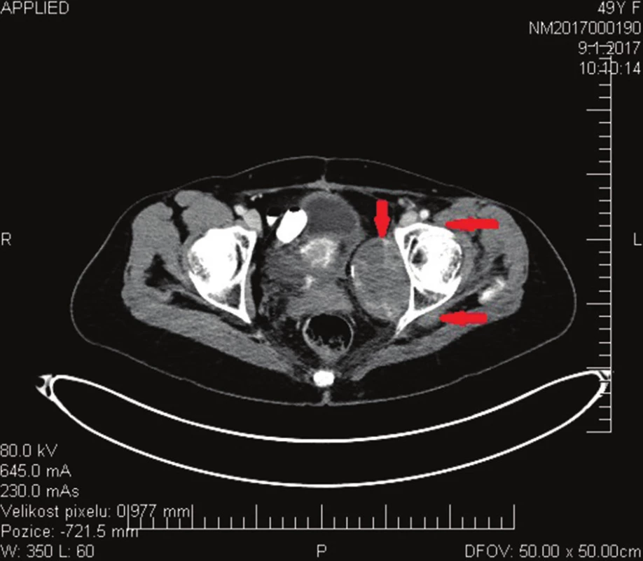 PET/CT vyšetření – progrese 1/2017
Fig. 4: PET/CT scan – progression in 1/2017