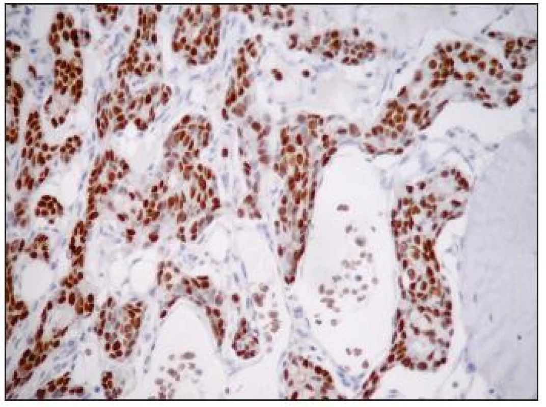 Nádorové buňky vykazovaly silnou jadernou pozitivitu při průkazu CDX-2. Trepanobiopsie, imunohistologie, velké zvětšení.