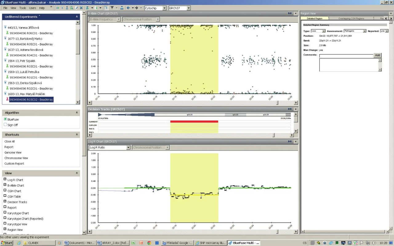 <b>SNP microarray analýza.</b>
A – oranžově označená oblast reprezentuje detekovanou hemizygotní deleci chromosomu 22, chybí signály pro heterozygotní SNP (osa y – 0,50)
B – částečný idiogram chromosomu 22, červeně vyznačen rozsah delece v pruhu q11.21 (2,9 Mb)
C – pokles intenzity fluorescence v oblasti delece 22q11.21
Fig. 3. <b>SNP microarray analysis.</b>
A – orange marked region represents detected hemizygous 22q deletion; signs for heterozygous SNP are absent (y-axis – 0,50)
B – partial 22 chromosome idiograms, red designated area of deletion in q11.21 band (2,9 Mb)
C – fluorescence intensity decline in deleted region 22q11.21