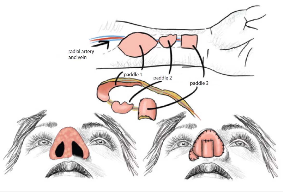 Burget-Walton technique of Chinese fl ap nose reconstruction. (Drawing by A. Berkeš according to [2]).