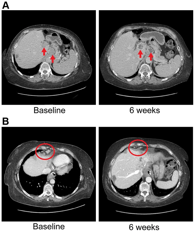 Anti-tumor activity in Patient 4 harboring an <i>FGFR2-MGEA5</i> fusion, to FGFR inhibitors.