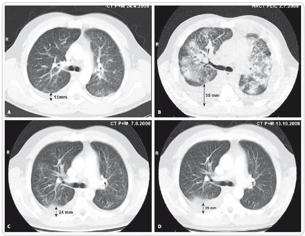 A) CT vyšetření plic a mediastina v době před stanovením diagnózy bronchioloalveolárního karcinomu. V popisu CT a předchozího HRCT zhodnoceno jako: „Oboustranný intersticiální plicní proces charakteru fi brotizující alveolitidy s mikro- až makronodulací.“ (Vyšetření provedeno mimo MOÚ). B) HRCT vyšetření plic provedené v době progrese onemocnění po 2. sérii iniciální chemoterapie v režimu karboplatina/paklitaxel: „V plicním parenchymu oboustranně poměrně symetrická, výrazná alveolární infiltrace s max. perihilózně, spíše vynechávající periferní peripleurální partie plic, s patrným air-bronchogramem bilat. Ve srovnání s dokumentací z 24/4/08 nález ve výrazné progresi.“ V této době je pacient v celkově velmi špatném stavu (PS 3), manifestovaném zejména klidovou dušností (saturace SpO<sub>2</sub> 74 %, měřeno puzlním oxymetrem, bez oxygenoterapie) a intermitentním dávivým kašlem s bronchorrheou. C) CT vyšetření plic a mediastina provedené 1 měsíc od zahájení cílené léčby inhibitorem tyrozinkinázové aktivity EGFR – erlotinibem: „Prokázána výrazná regrese velikosti i rozsahu měkkých převážně alveolarních infi ltratů v obou plicních křídlech a regrese pleurálních výpotků.“ D) CT vyšetření plic a mediastina provedené 3 měsíce od zahájení léčby erlotinibem: „Další regrese nízce denzních infiltrátů v plicním parenchymu bilat. Fluidothorax vpravo lehce výraznější, vlevo regrese ad integrum. Uzliny v mediastinu již stacionární. Karcinomatóza skeletu stacionární.“
Vyšetření provedli: MUDr. Petr Opletal, MUDr. Renata Belánová, MUDr. Michal Standara.