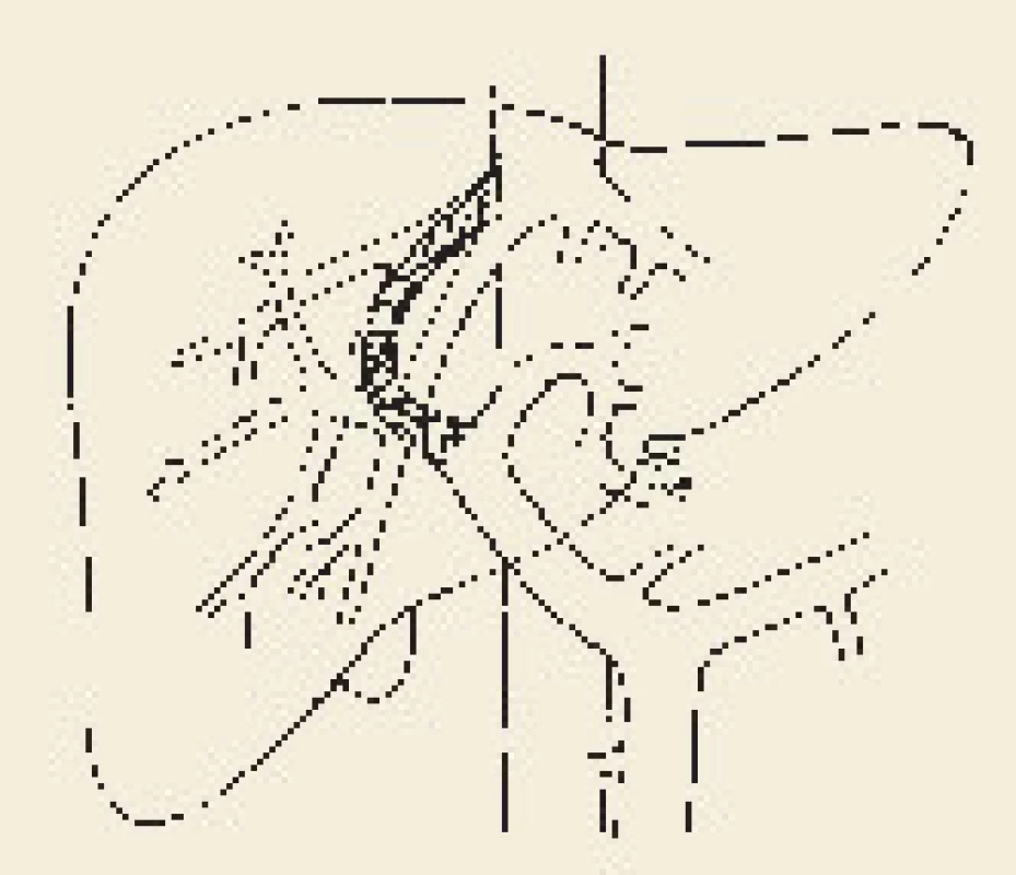 Schéma transjugulární intrahepatální portosystémové spojky (TIPS).
Fig. 1. Diagram of transjugular intrahepatic portosystemic shunt (TIPS).