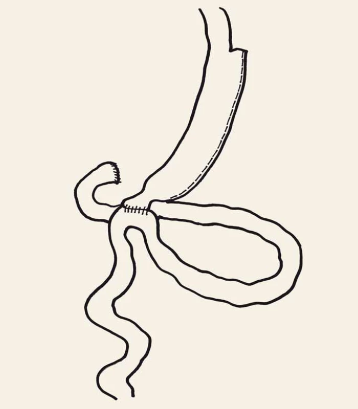 Duodenoileální anastomóza s rukávovou resekcí žaludku.
Fig. 5. Single anastomosis duodeno-ileal bypass with sleeve gastrectomy.