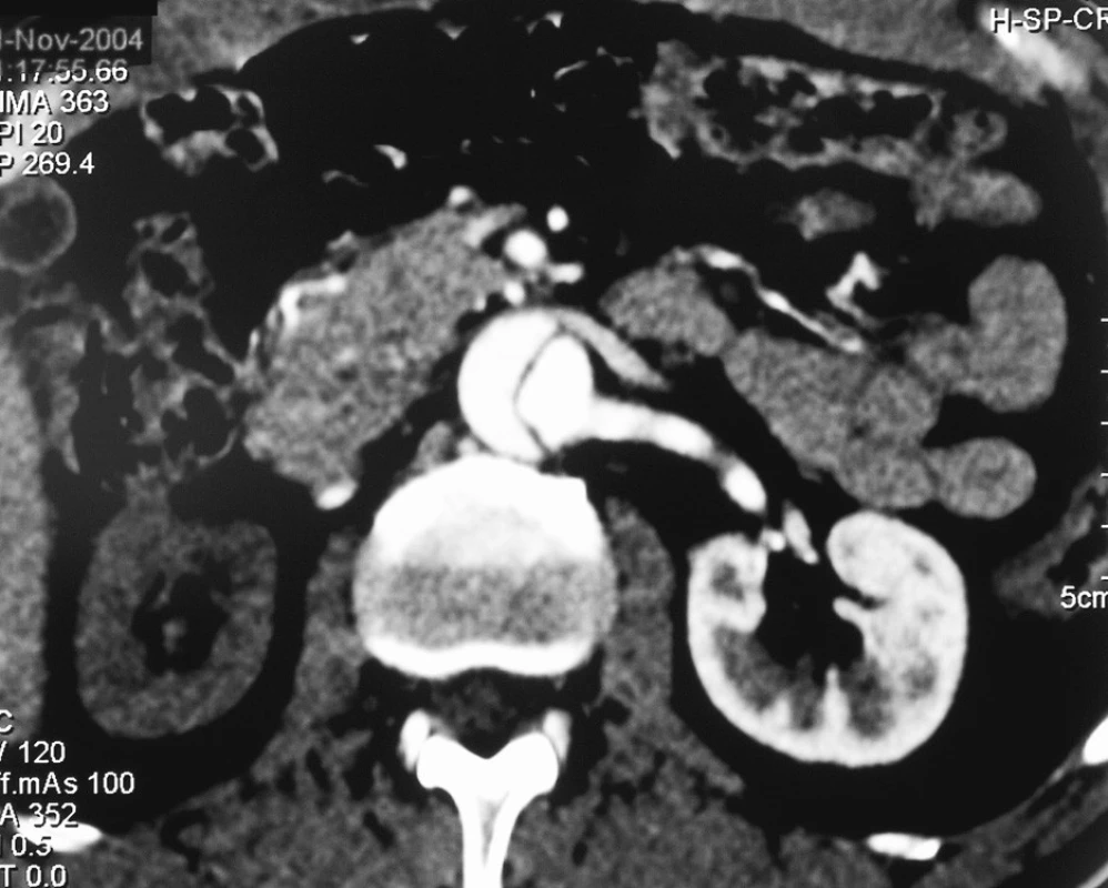 Disekce typu B pokračující na břišní aortu s uzávěrem pravé renální tepny
Pic. 2. The type B dissection involving the abdominal aorta with a closure of the right renal artery