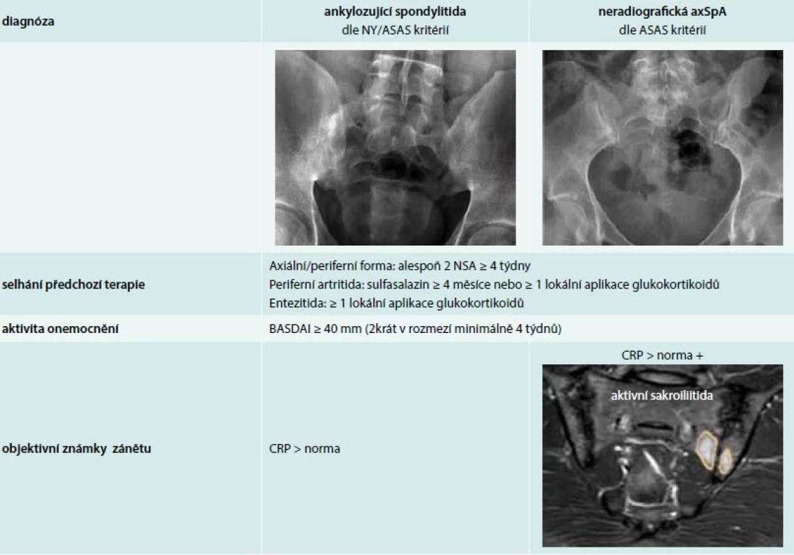 Indikace biologické terapie AS a neradiografické axSpA dle doporučení České revmatologické společnosti (ČRS). Upraveno podle [18]