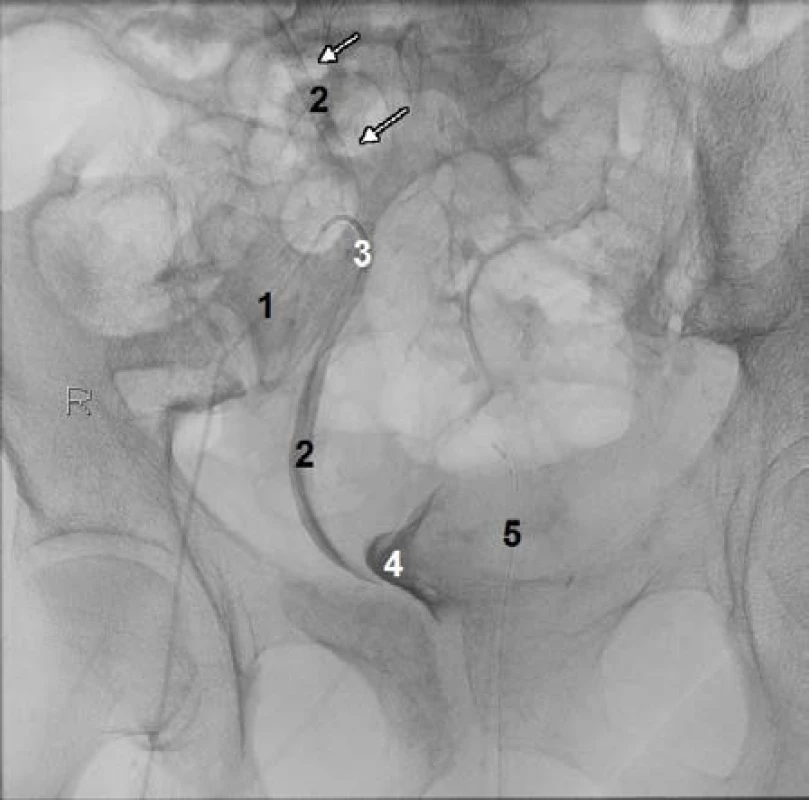 Ilikoureterální píštěl. 1) Katétr v tepně (zevní ilická arterie vpravo), 2) močovod, 
3) ilikoureterální píštěl, 4) močový měchýř, 5) močový katétr
Fig. 3 Ilicoureteral fistula. 1) Catheter in an artery (right external iliac artery), 2) ureter, 
3) ilicoureteral fistula, 4) urine bladder, 5) urinary catheter
