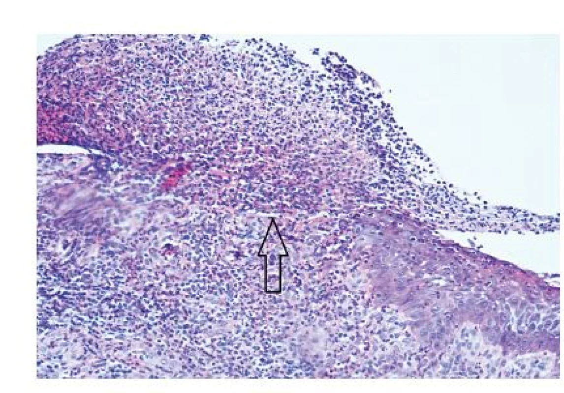 Histologický preparát vzorku ze sliznice ústní dutiny, barvení hematoxylin-eosin, šipka ukazuje na ulceraci epitelu.