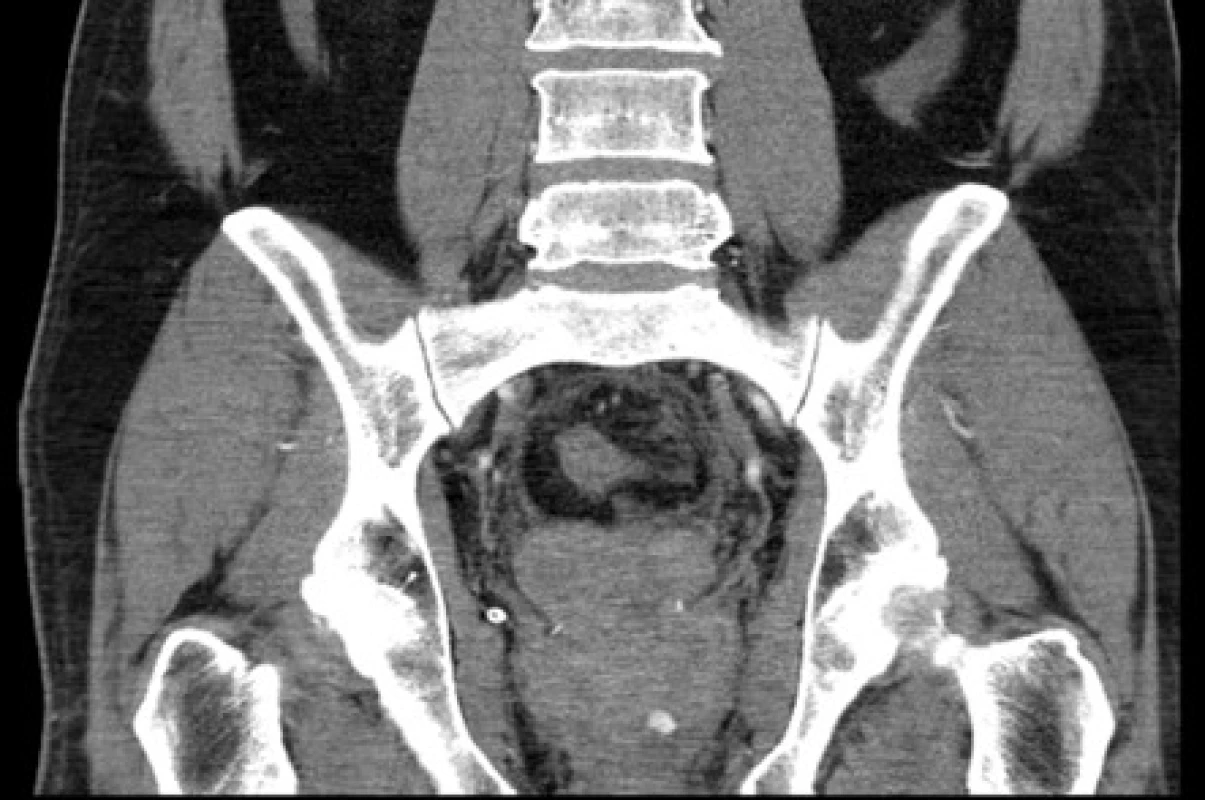 <i>CT – arteriální leak vlevo po prostatektomii – frontální řez</i>
Fig. 2. <i>CT scan: arterial leak on left side after prostatectomy – coronal view</i>