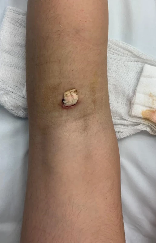 Primární ošetření – popliteální oblast a tuberozitas tibie, původní tampony pořád v ráně 