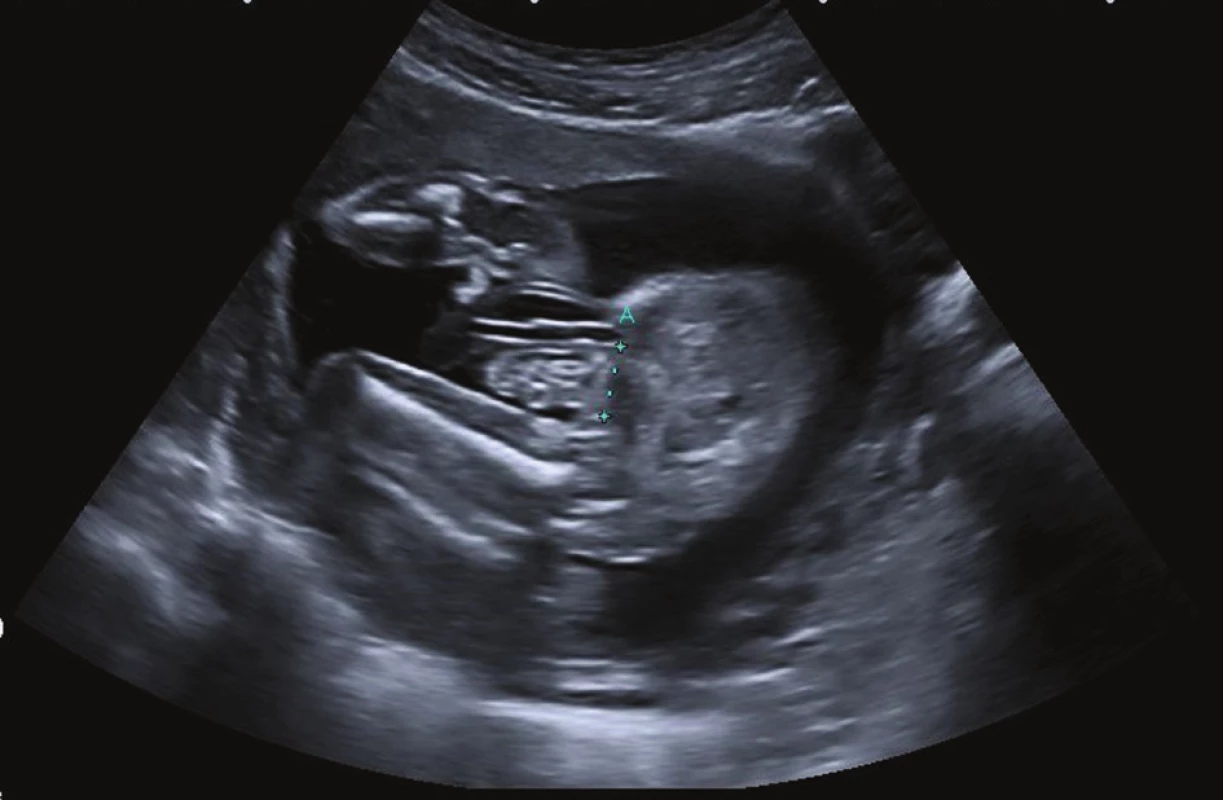 Prenatální ultrazvukové vyšetření u gastroschízy
Fig. 2: Prenatal ultrasound scan of gastroschisis