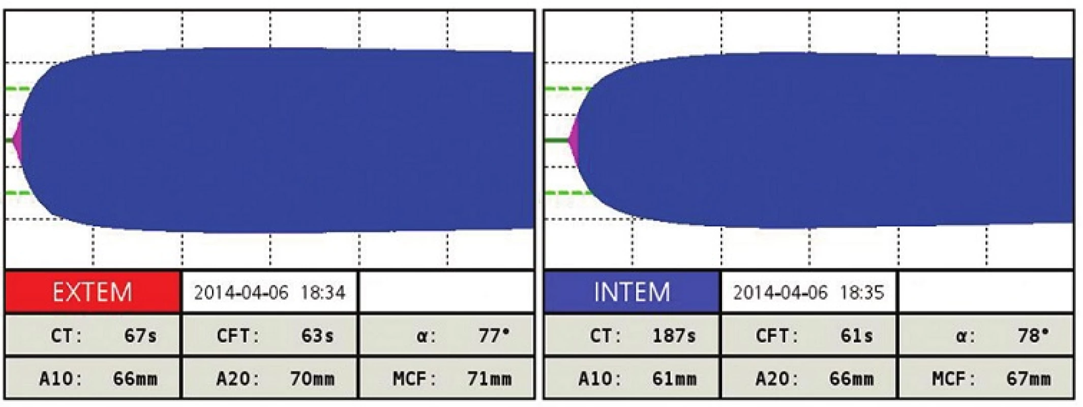 ROTEM po terapii pri INR 1,8
Všetky parametre EXTEM a INTEM sú v norme.
Fig. 3: ROTEM after the treatment with INR 1.8
All parameters of EXTEM and INTEM are normal.