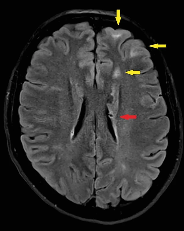 MRI mozku – kortiko-subkortikálně uložené tubery frontálně vlevo (žluté šipky) a hamartom při postranní komoře vlevo (červená šipka) (foto: doc. MUDr. Stanislav Buřval, Ph.D., Radiologická klinika FN Olomouc)