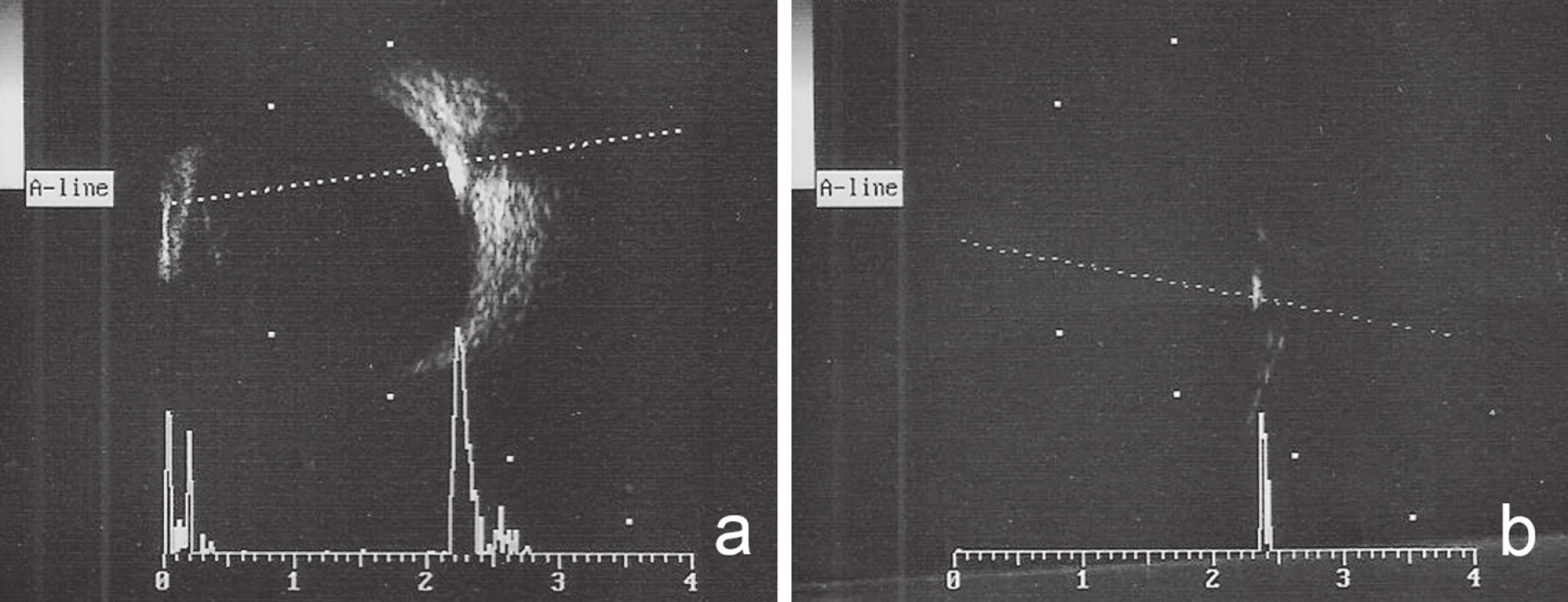 Ultrasonografie pravého oka. Zobrazení drúzové papily při normálním zisku signálu (gain 68 dB) a), hyperechogenita drúzové papily při sníženém zisku signálu (gain 40 dB) b)