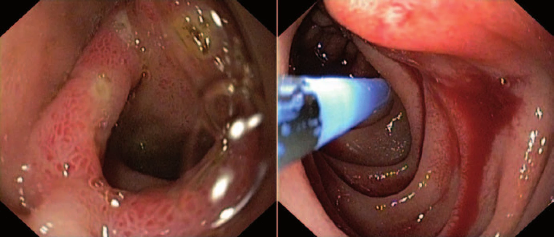 Ezofagogastroduodenoskopia. Vľavo: prechod D1–D2 duodena po ošetrení APC. Vpravo: aktívne krvácanie v D3 duodena.
Fig. 1. Ezofagogastroduodenoscopy. Left: Interface D1–D2 of duodenum after treatment with APC. Right: active bleeding in D3 of duodenum.