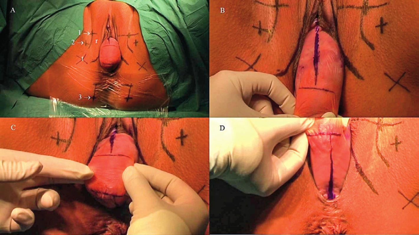 Demonstrace klinického nálezu pacientky s komplexním urogenitálním prolapsem indikované k zavedení kotveného implatátu. POP-Q: Aa 2, Ba 3, C 4, Ap 1.5, Bp 2.5, gh 5, pb 3.5,