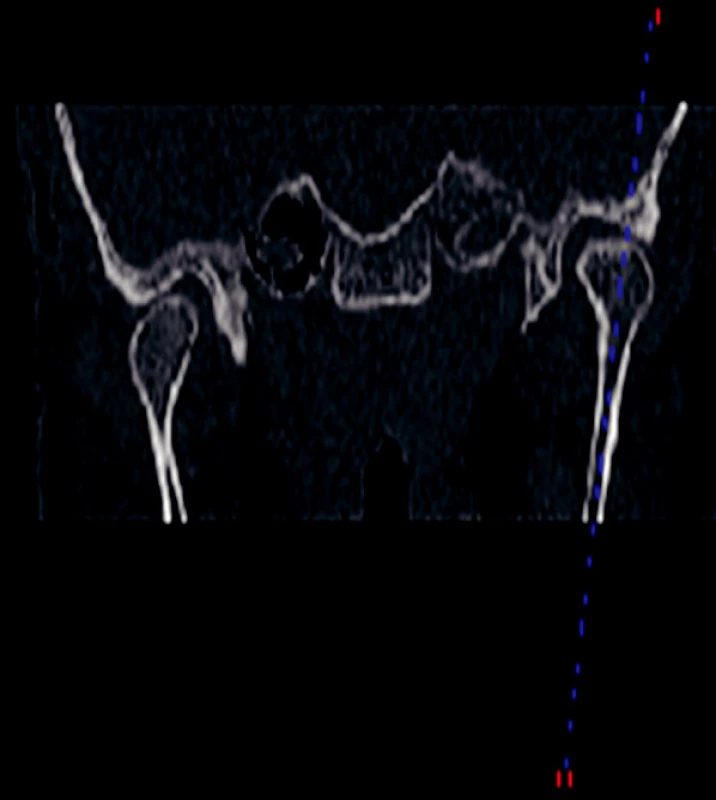 MRI snímek TMK předozadní.