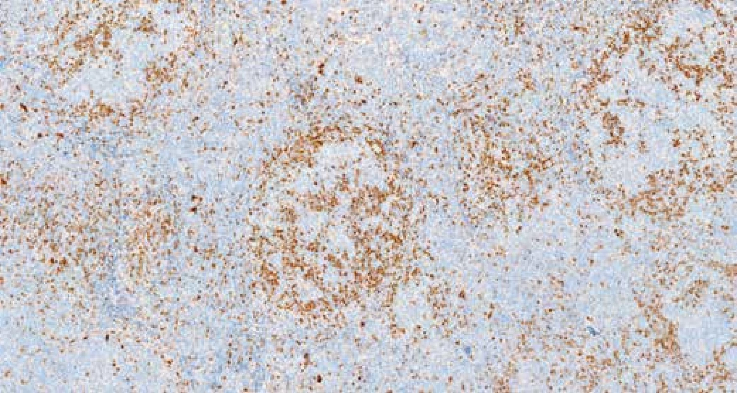 Imunohistochemický průkaz exprese cyklínu D1 v elementech na periferii folikulárních formací, do kterých místy tyto buňky i pronikaly. Zvětšení 200x.