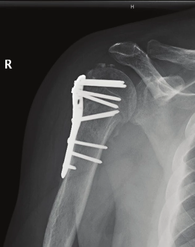RTG obraz implantace PHILOS dlahy. RTG obraz pooperační