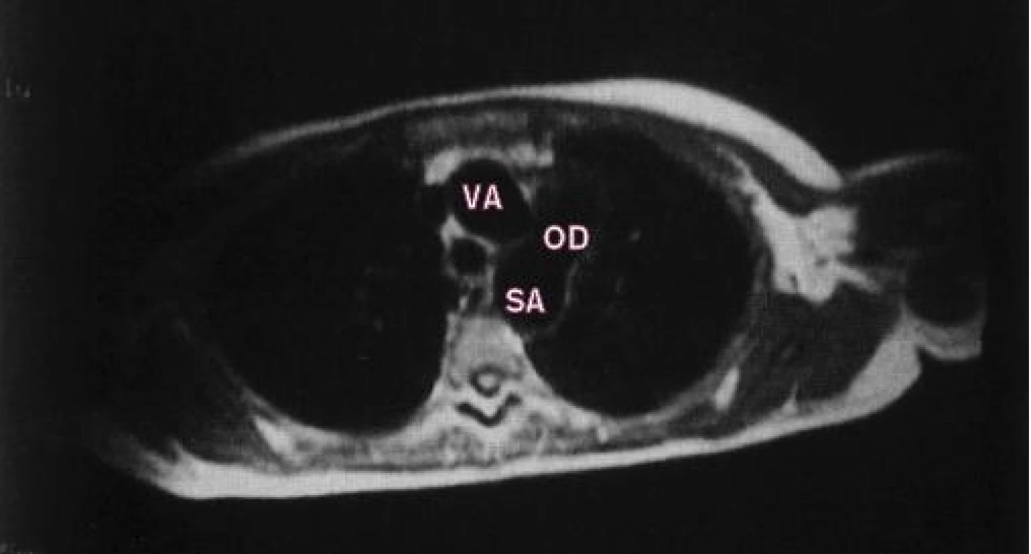 MRI-spin-echo otevřené dučeje v transaxiální rovině.