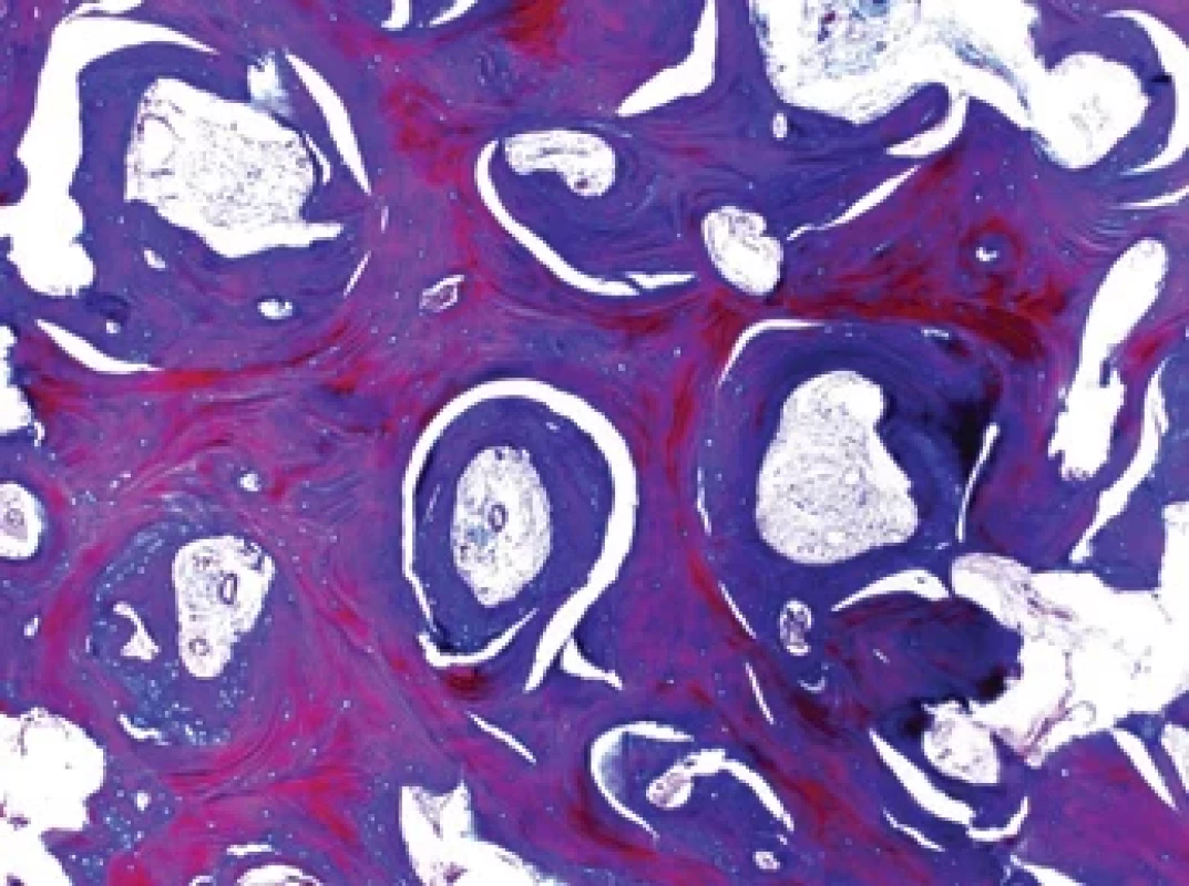 Histologický obraz sklerotické kosti lebky obarvené modrým trichromem. Vitální nově vytvořená kost je v červeném odstínu, na rozdíl od modrých zbytků nekrotické kosti, kde převládají prázdné osteocytární lakuny po odumřelých osteocytech. Barveno modrým trichromem.