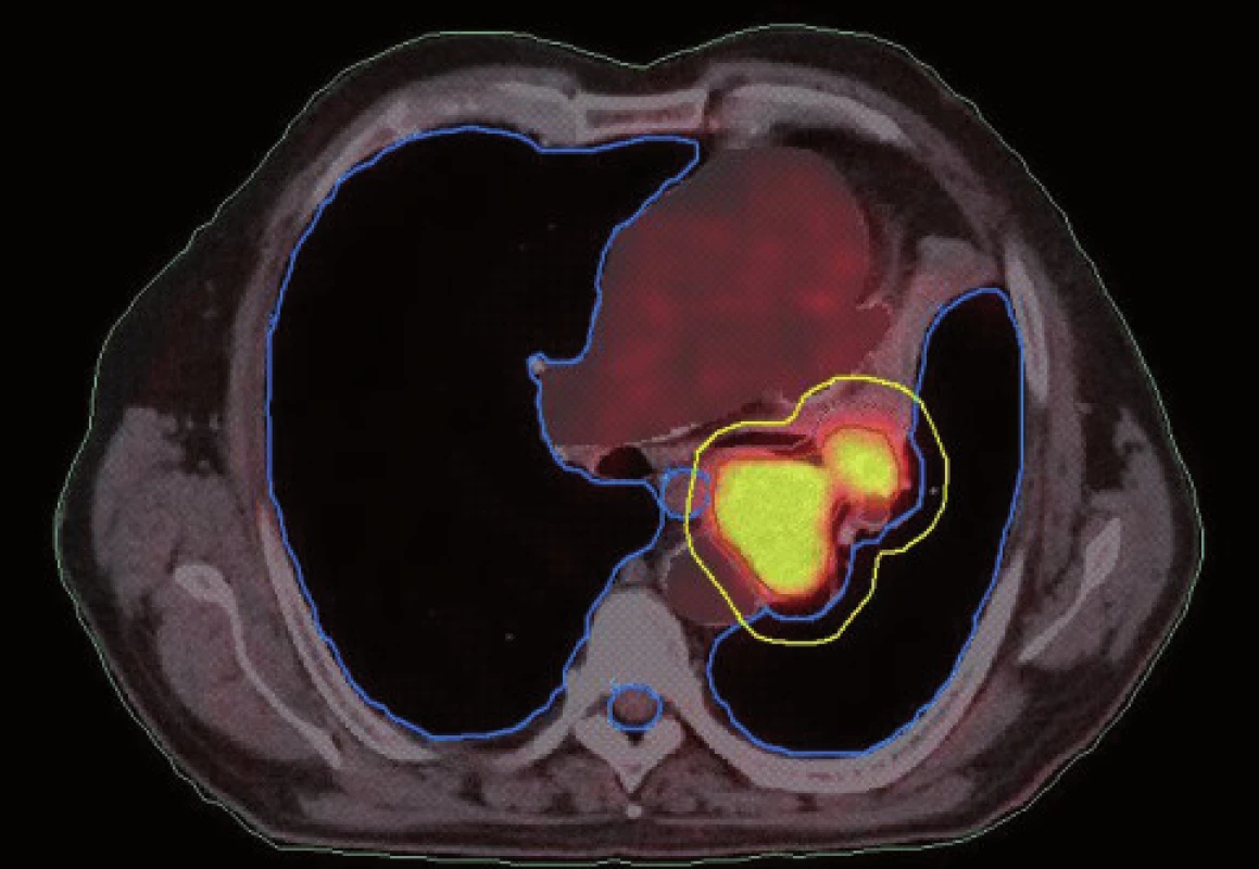 Konturace podle PET/CT ve stejném řezu jako na obr. 7. Evidentní zmenšení velikosti cílového objemu.