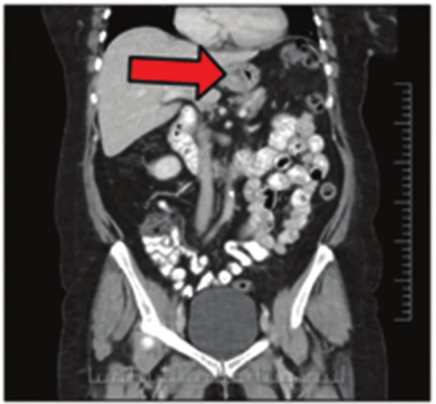 GIST žaludku na CT snímku
Fig. 2: Gastric GIST on CT scan