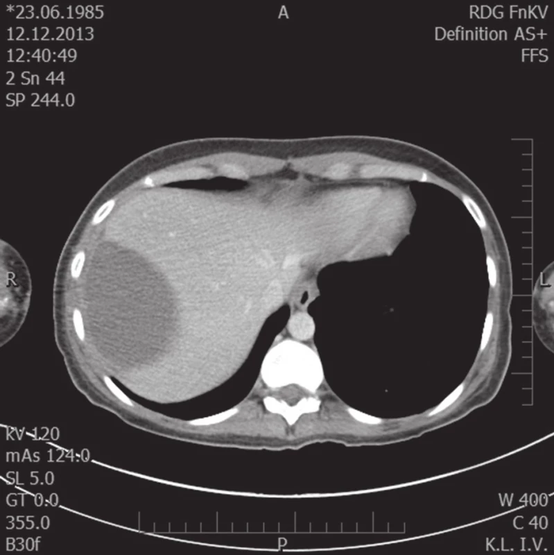 Kontrolní CT vyšetření za 7 týdnů, regrese hematomu
Fig. 3. Follow-up examination 7 weeks after injury, regression of hematoma
