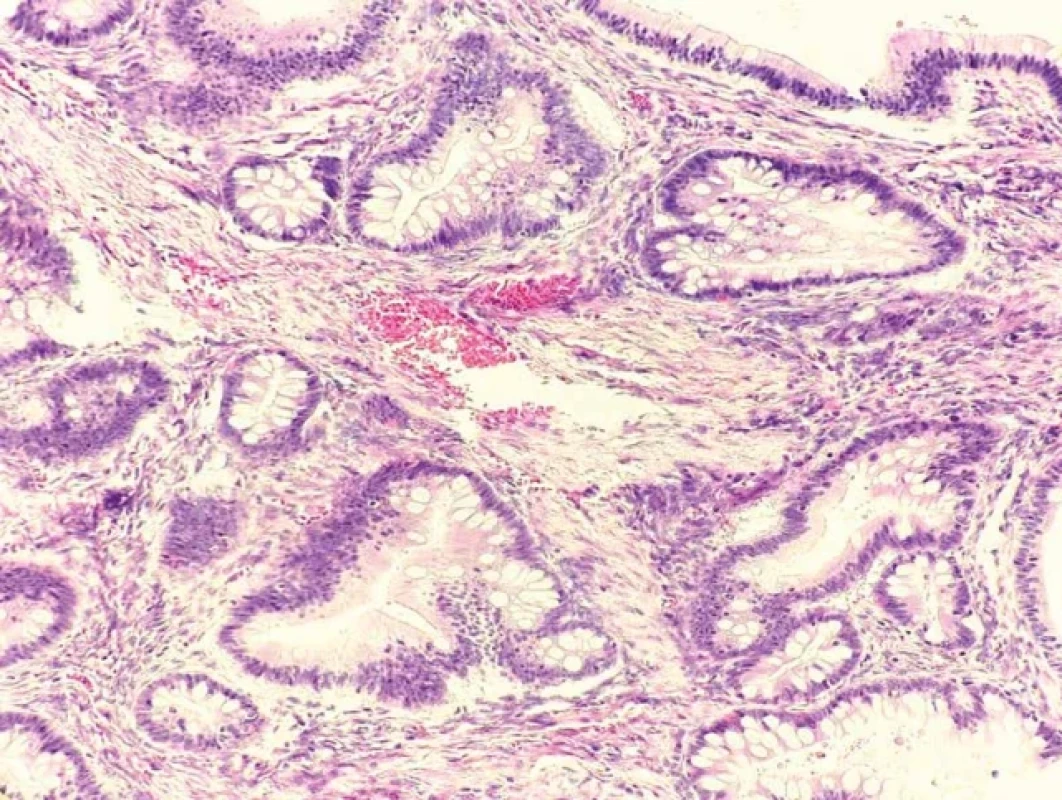 Detail na nádorový žľazový epitel s  „pohárikovou“ (goblet-cell) diferenciáciou (farbenie hematoxylínom a eozínom, zväčšenie objektívu 20×) 