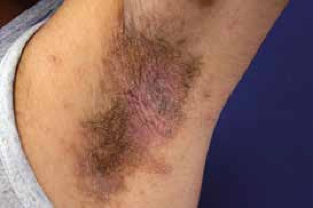 Acanthosis nigricans