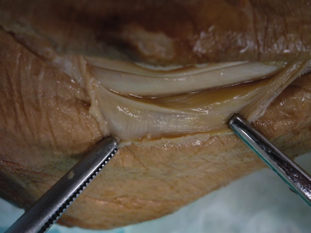 SPR viditelné jako fibrotické zesílení bércové fascie a pochvy peroneálních šlach