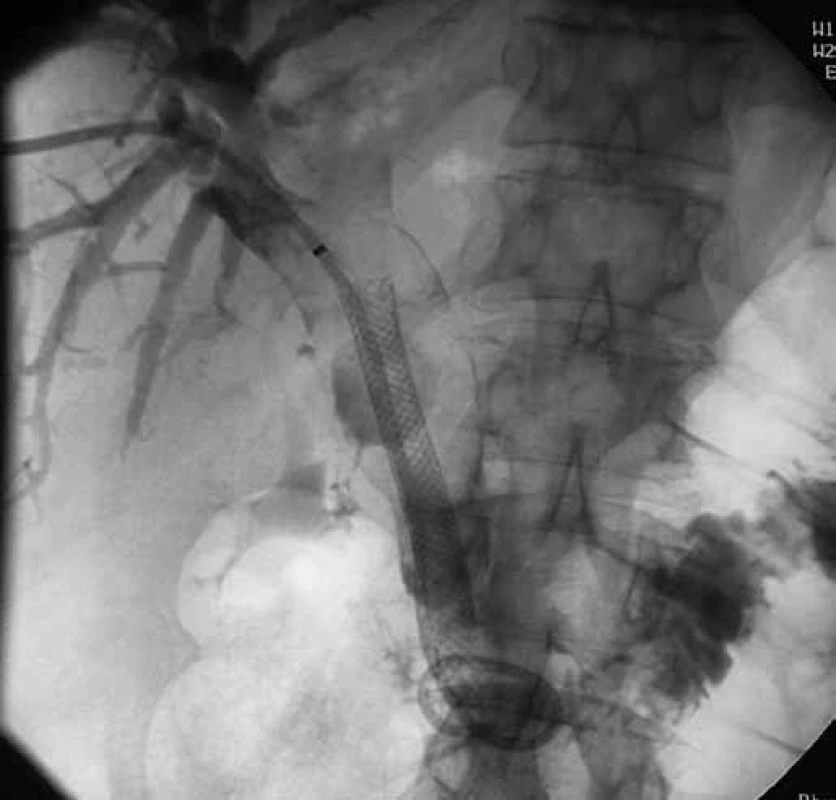 Perkutánní transhepatální drenáž, dilatace extrahepatálních i intraheptálních žlučovodů.
Fig. 3. Percutaneous transhepatal drainage, dilatation of the extrahepatal and intrahepatal bile ducts.