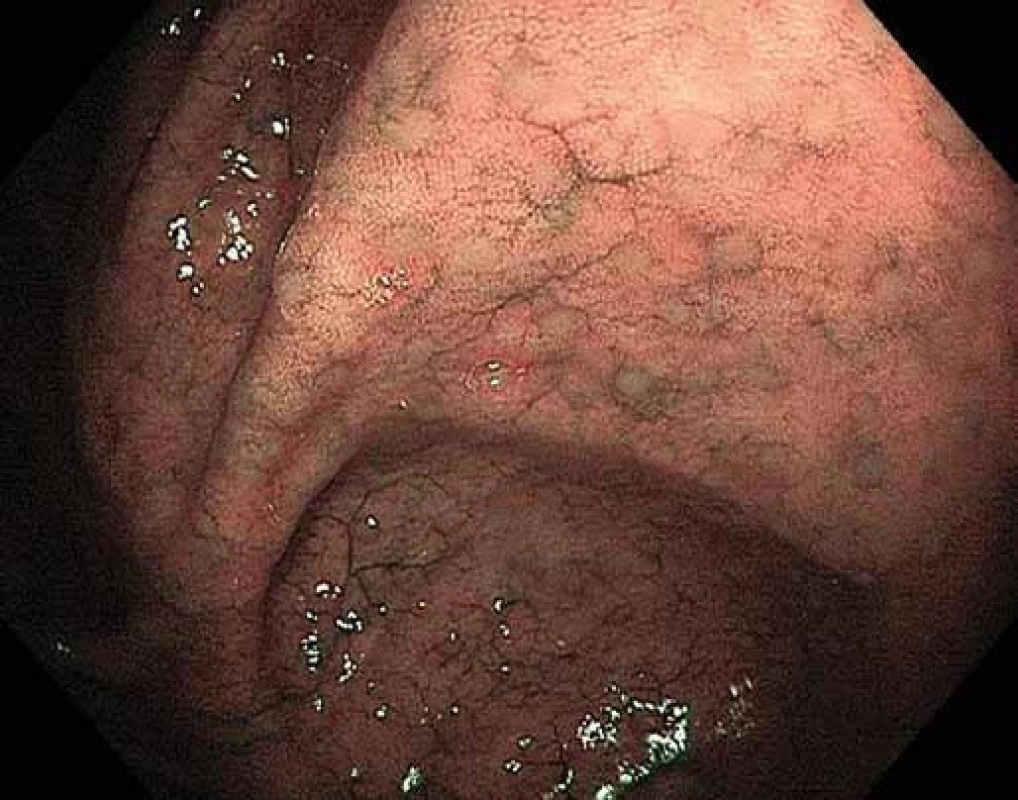 Normální tračník, slizniční lymfatické folikuly (drobná okrouhlá mírně prominující ložiska), zvýraznění pomocí narrow band imaging.
Fig. 6. Normal colon, mucosal lymphatic follicles (small circular slightly protruding spots), highlighted by narrow band imaging.