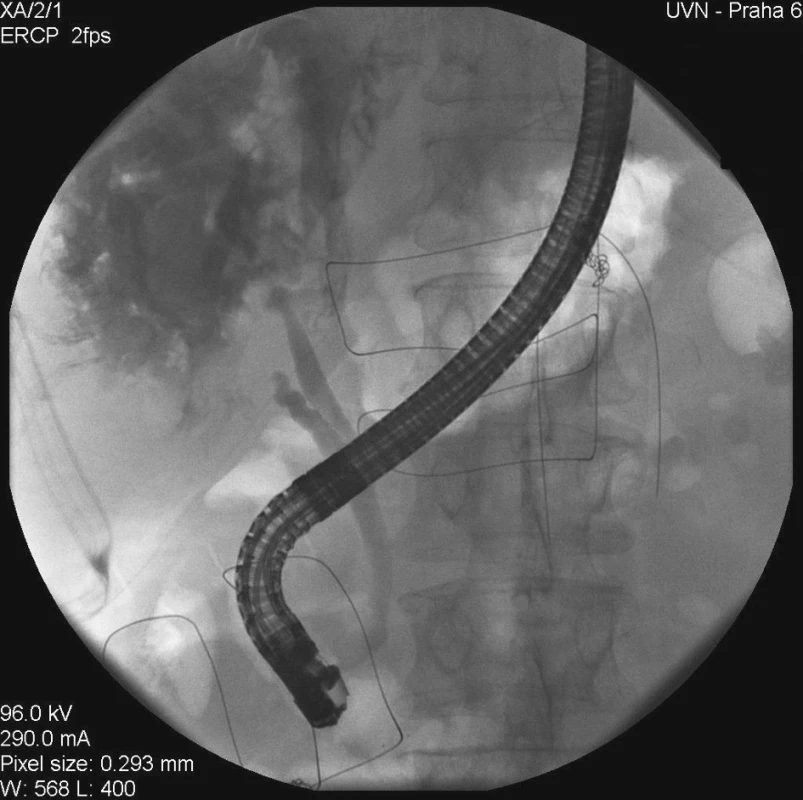 Únik kontrastní látky ze žlučového stromu při ERCP
Fig. 1. A contrast matter leak from the biliary tree during ERCP