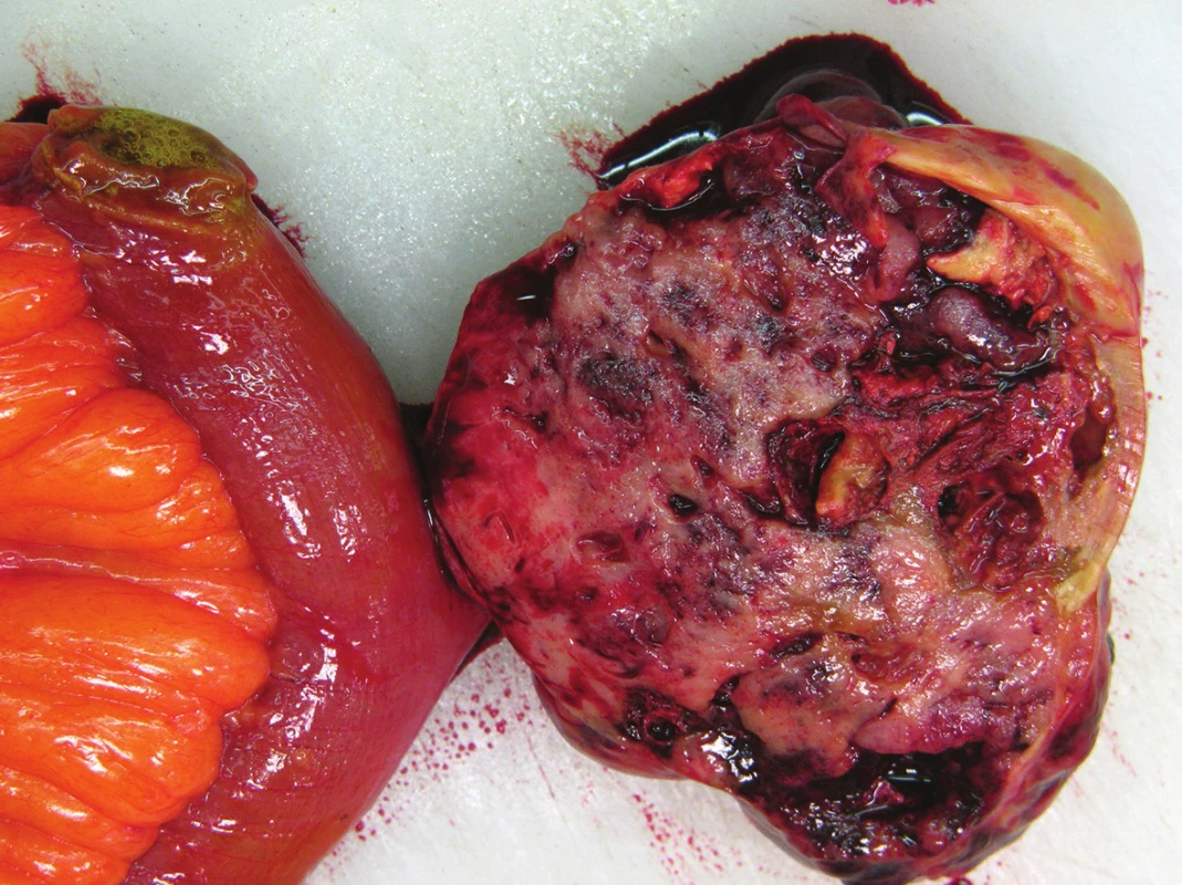 Gastrointestinální stromální tumor ilea
Fig. 3: Gastrointestinal stromal tumor of the ileum