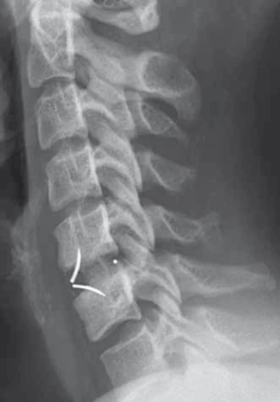 Pooperačný laterogram po implantácii klietky ROI-C<sup>®</sup> v segmente C5–C6 (archív autora).
Fig. 2. Lateral X-ray image after ROI-C<sup>®</sup> cage implantation in segment C5–C6 (author’s archive).
