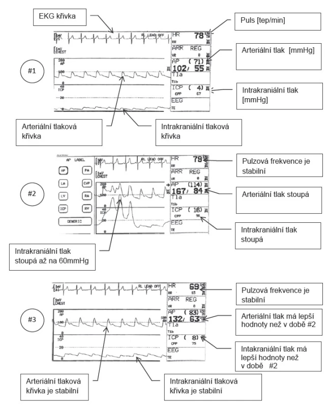 Interference pacientské dechové activity a přístrojovými dechy umělé plicní ventilace
#1 Hodnoty ICP, AP a HR před interferencí. Všechny hodnoty jsou prakticky normální.
#2 ICP velmi roste až na hodnoty 60 mmHg. Roste I arteriální tlak při stabilní tepové frekvenci.
#3 Po aplikaci relaxační medikace jsou všechny hodnoty prakticky normální.