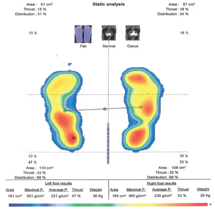 Static plantar pressure measurement.