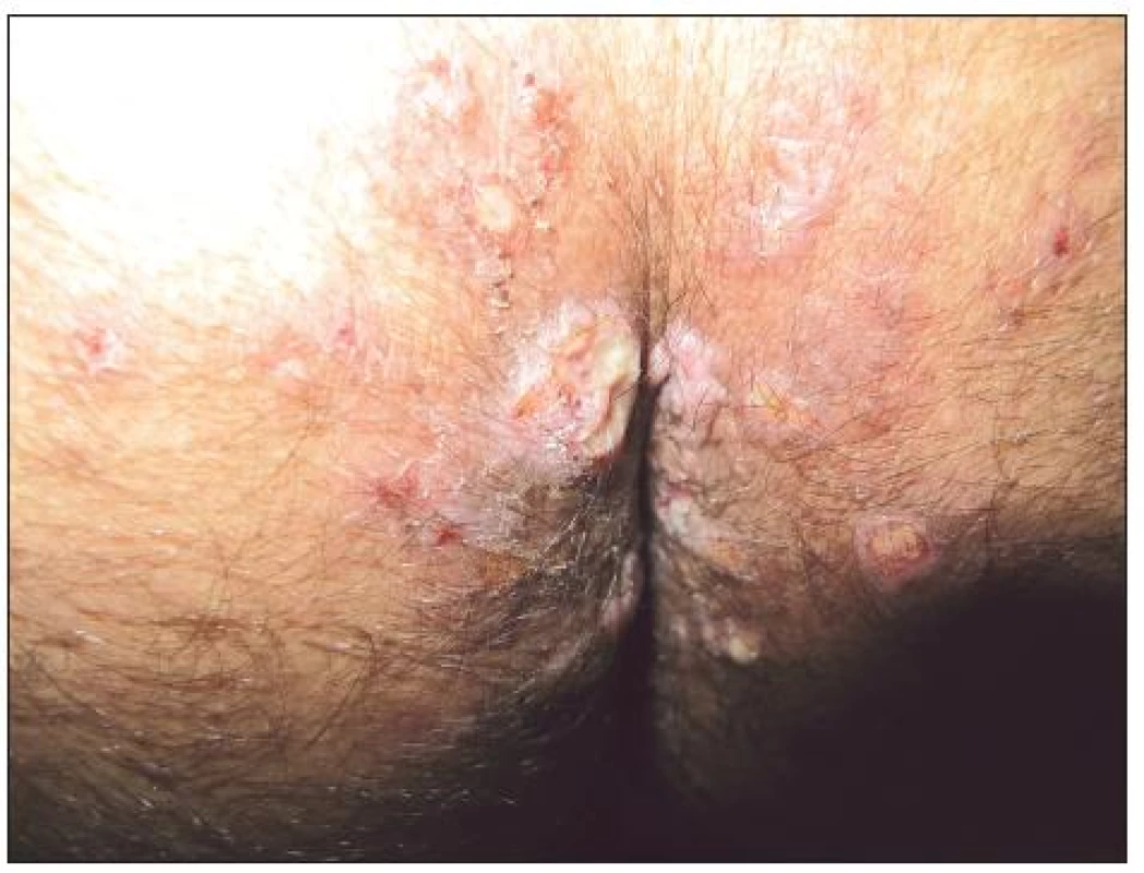 Condylomata lata u HIV pozitivního pacienta