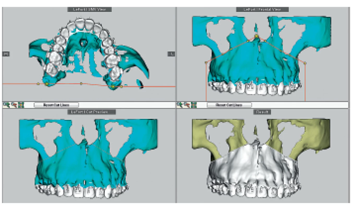 Osteotomie – LeFort I