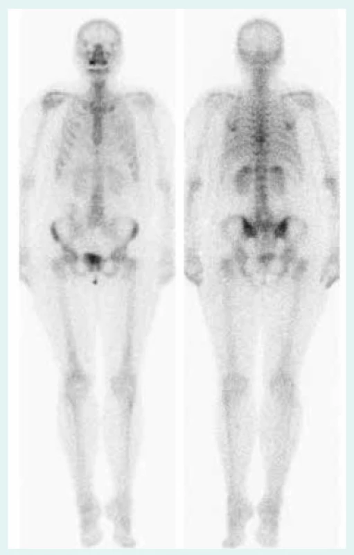 Scintigrafie (duben 2013) – regrese patologické infiltrace v Th10 a plicní aktivity