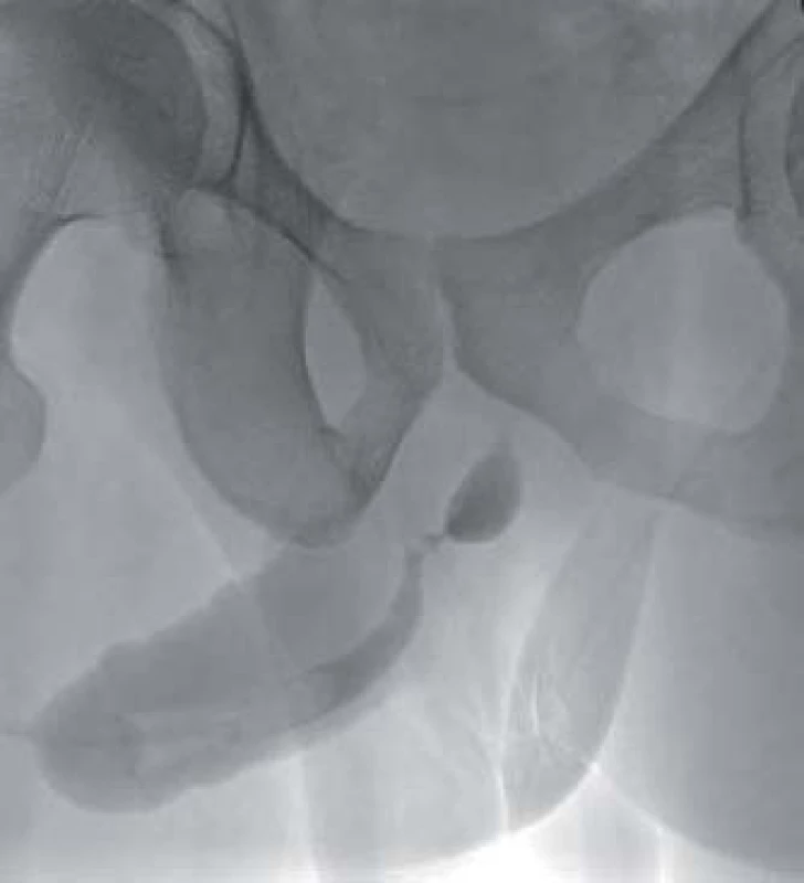Striktura uretry – ureterografie.