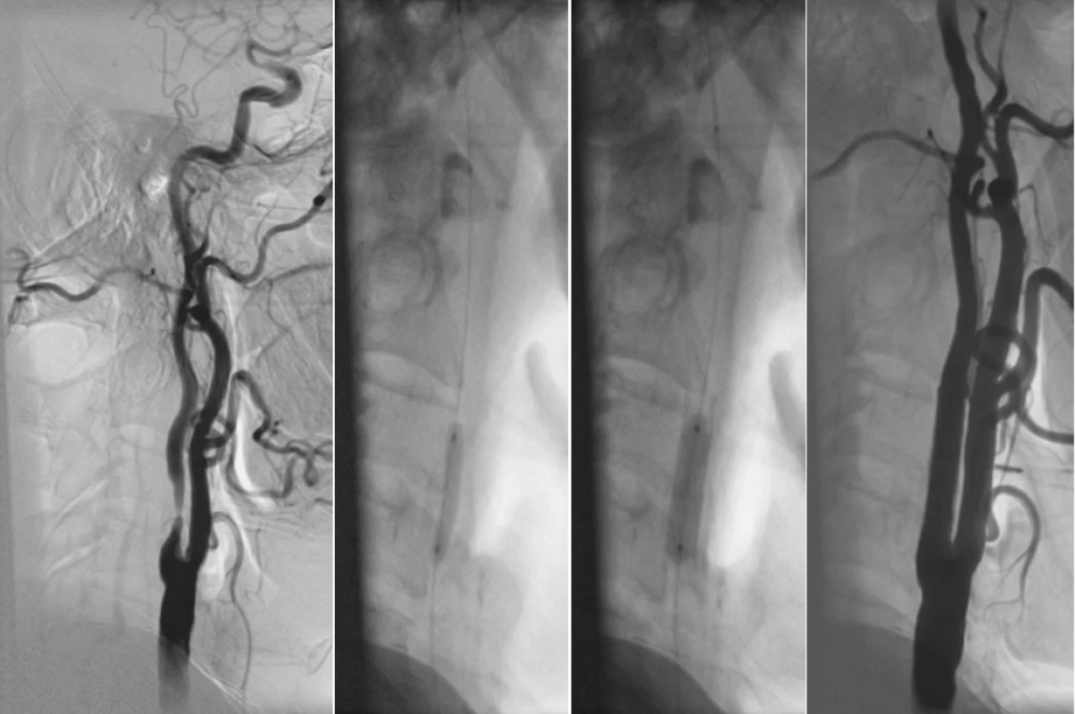 70letý muž s recidivujícími TIA z pravé hemisféry, ICHS, plicní fibrózou. Na USG zjištěna 80% stenóza a. carotis interna dx. A) Angiogram pravé karotické tepny se stenózou 80 %. B) Stav po zavedení protektivního filtru do ACI pod lební bázi (šipka), predilatace stenózy 3x 20mm balonkem. C) Stav po zavedení samoexpandibilního stentu a jeho dodilatování 6x 20mm balonkem. D) Výsledný angiogram ukazuje průchodnou ACI bez reziduální stenózy. 
Fig. 1. A 70-year old male with relapsing TIAs in the right hemisphere, cardiac ischemia, pulmonary fibrosis. On ultrasound examination, 80% stenosis of a. carotis interna dx was detected. A) Angiogram of the right carotid artery with a stenosis of 80 %. B) Status post introduction of a protective filter into the ACI below the skull base (arrow), 3x 20 mm balloon predilatation of the stenosis. C) Status post introduction of a selfexpandible stent and its further 6x 20 mm balloon dilatation. D) The final angiogram depicts unobstructed ACI without any residual stenoses.